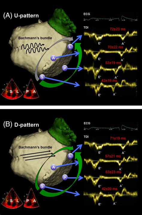 Left Atrial Activation And Asymmetric Anatomical Remodeling In Patients