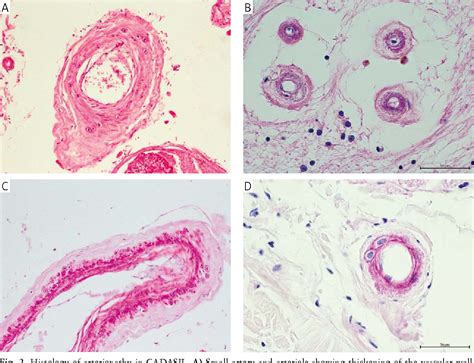 Figure 2 From Cerebral Autosomal Dominant Arteriopathy With Subcortical Infarcts And