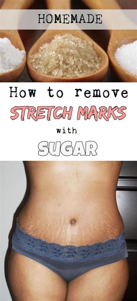 How To Remove Stretch Marks With Sugar Home Remedies To Help