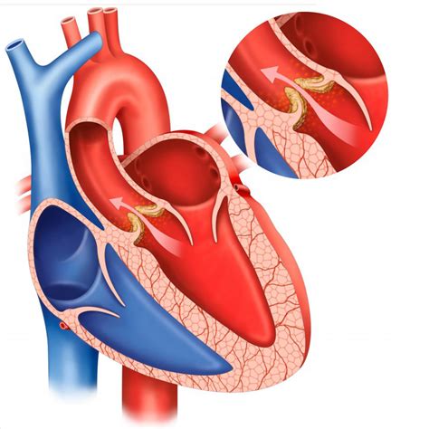 Obstrucción al flujo sanguíneo cardiaco Homo medicus