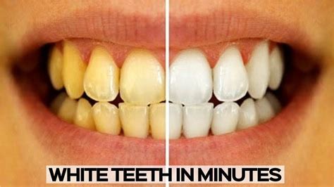 Why In Office Teeth Whitening Deserves The Cost Tompkins Oral Basic