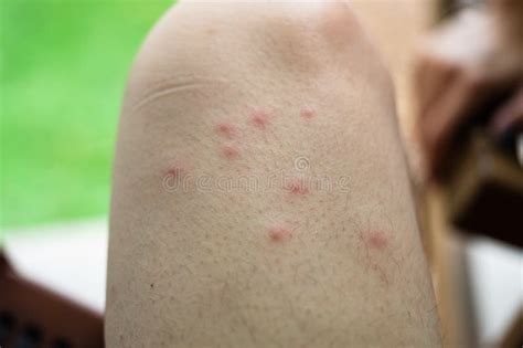 Mosquito Bites Sore Scar Stock Photos Free Royalty Free Stock