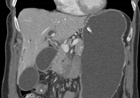 Pancreatic Cancer Invades And Obstructs The Duodenum Pancreas Case