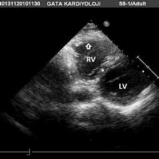 Transthoracic Echocardiogram From Left Parasternal Basal Short Axis