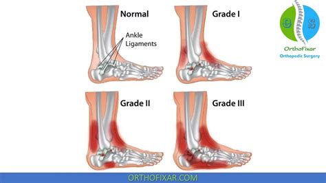 Lateral Ankle Sprain | OrthoFixar 2024