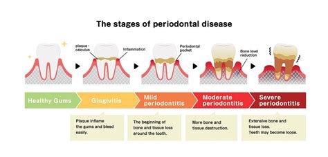 Orange Ca Periodontal Treatments For Gum Disease