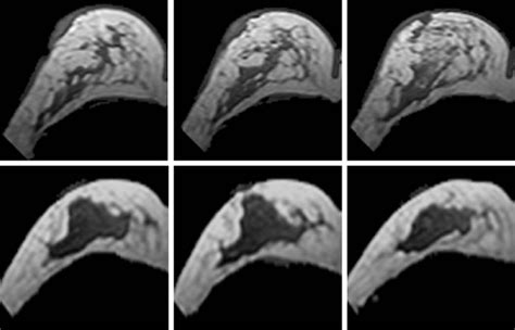 Figure 6 From Quantitative Analysis Of Breast Parenchymal Patterns