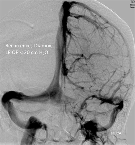 Case Archives Venous Pulsatile Tinnitus