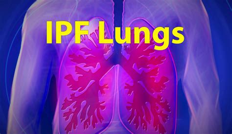 Researchers Continue To Study Idiopathic Pulmonary Fibrosis Wink News