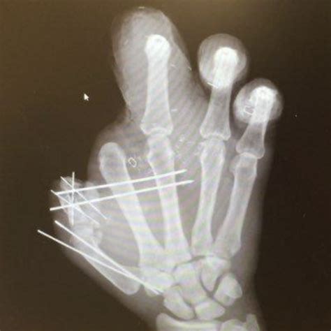 X Rays Of Hands The Day After The Fourth Of July Wtf Gallery