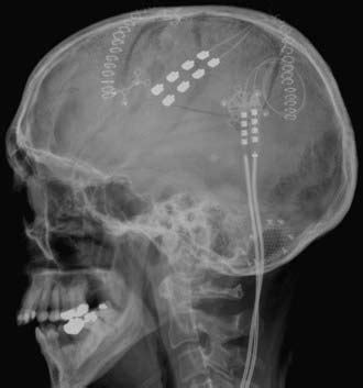 Motor Cortex Stimulation | Neupsy Key