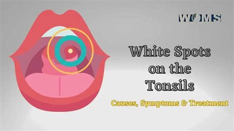 White Spots on the Tonsils: Causes, Symptoms and Treatment (2023)