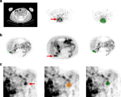 Voi Delineation Methods For Zr Immuno Pet Manual Tumor Delineation