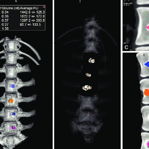 Three Dimensional Computed Tomography Scans For Volumetric Measurement