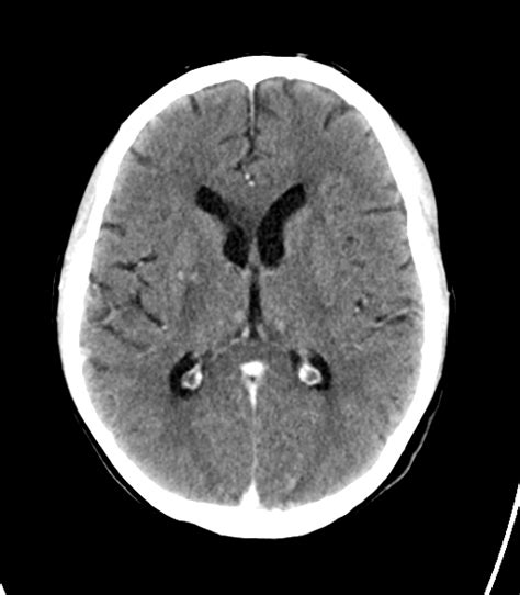 Innumerous Brain Metastases Image Radiopaedia Org