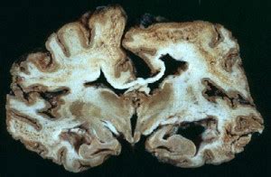 Creutzfeldt-jakob disease