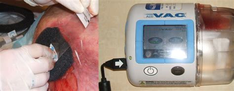 K Ci Wound Vac Application