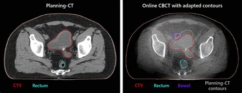 UMC Utrecht Debuts Elekta CBCT Linac for Adaptive Radiotherapy