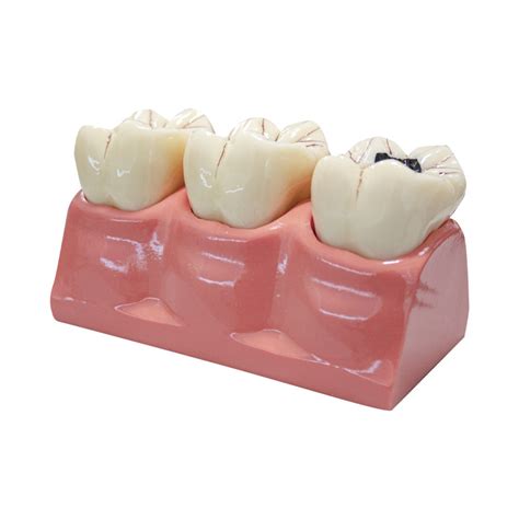 Caries Demonstration Model Frasaco Dental Product Pearson Dental