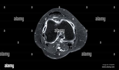 Mrt Kniegelenk Sagittal Fotos Und Bildmaterial In Hoher Aufl Sung Alamy