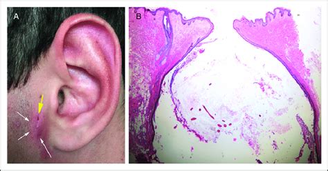 A Teenage Patient With Inflamed Cyst Of Hair Follicle Origin Black