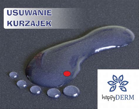 Usuwanie Kurzajek Wroc Aw Happyderm Dermatologia I Medycyna Estetyczna