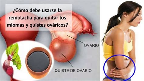 Cómo debe usarse la remolacha para quitar los miomas y quistes