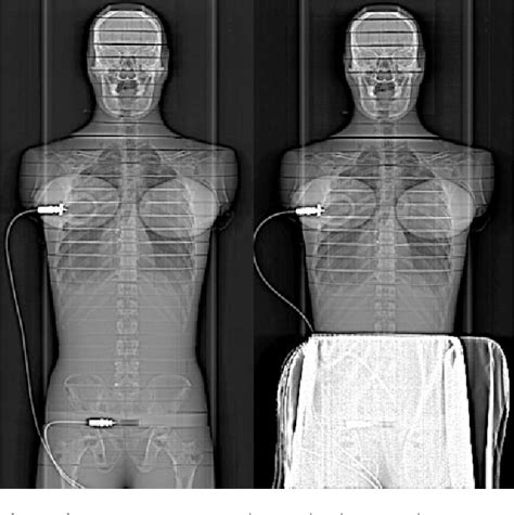 Figure 1 From Investigation Into The Effects Of Lead Shielding For Fetal Dose Reduction In Ct