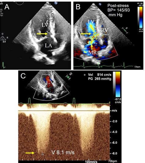 Measuring Left Ventricular Outflow Tract Signal Gradient In