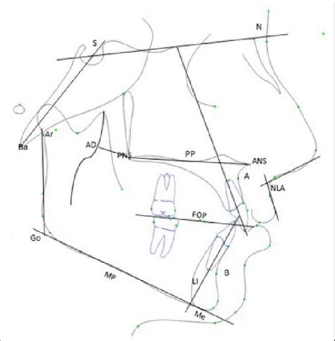 Lateral Cephalometric Reference Landmarks Planes And Angles Analysed