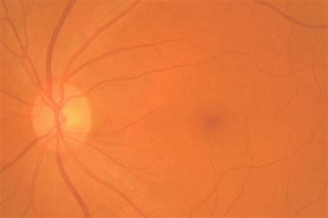 Causes of Epiretinal Membrane | Southern Vitreoretinal Associates