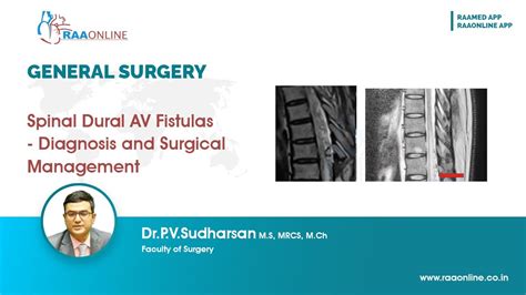 Spinal Dural Av Fistulas Diagnosis And Surgical Management Youtube