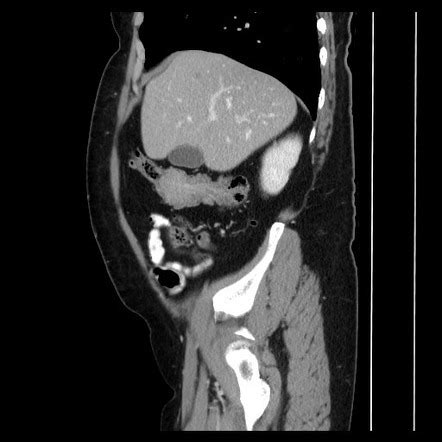 Colocolic Intussusception Due To Tubular Adenoma Radiology Case