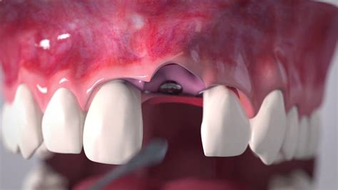 Soft Tissue Augmentation Around A Dental Implant 3d Animated Video Youtube