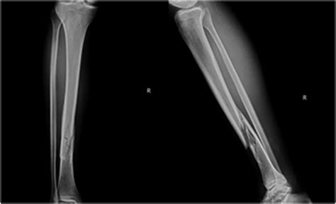 Preoperative Tibia Radiograph The Radiograph Shows Spiral Oblique