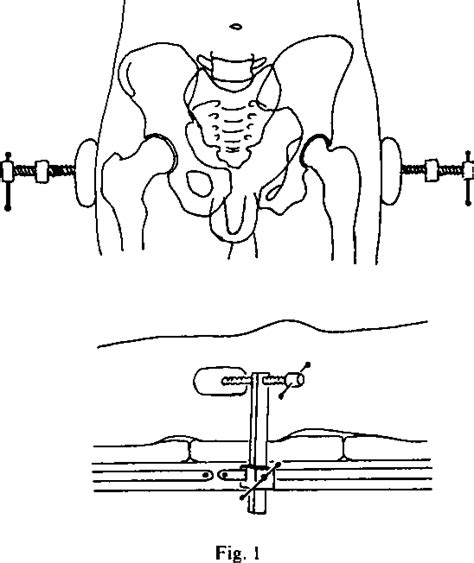 Figure 1 From A Technique For Reducing Diastasis Of The Symphysis Pubis Semantic Scholar