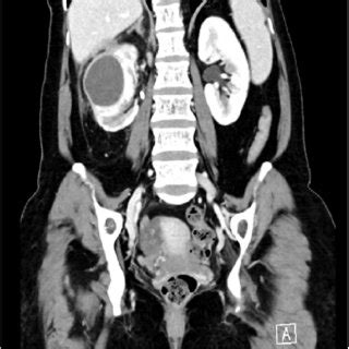 Coronal Section Of Abdominal Computerized Tomography Ct Scan Showing