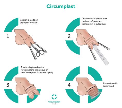 Circumcision Procedure Steps