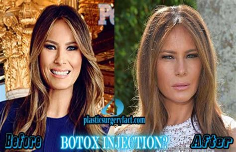 Melania Trump Plastic Surgery Before And After