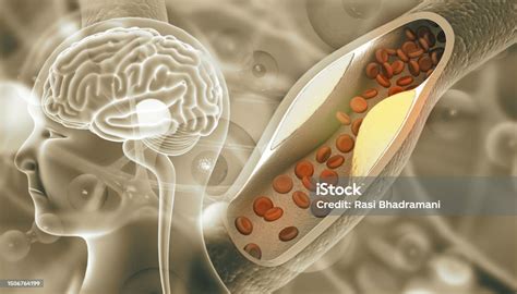 Human Brain Anatomy With Blocked Blood Vessels Stock Photo - Download Image Now - Anatomy ...