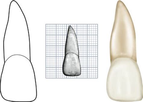 The Permanent Maxillary Incisors Pocket Dentistry