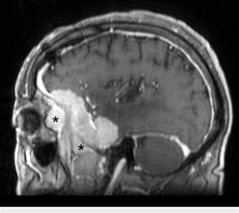 Preoperative Sagittal Mri Demonstrating Tumor Involvement Of The Download Scientific Diagram