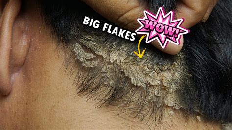 WOW SO Much Dandruff Big Flakes Removal Satisfying 397 YouTube