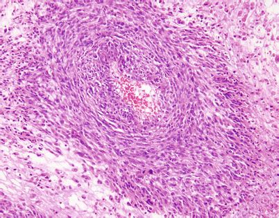 Soft Tissue Tumors of the Mediastinum | Basicmedical Key