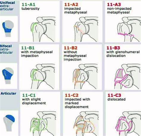 Humerus Ao Ota Classification Reprinted With Permission Copyright By Download Scientific