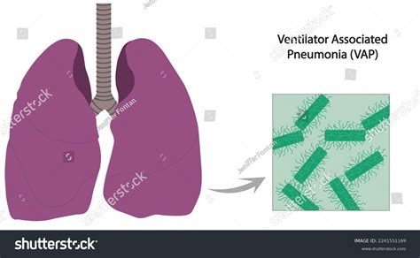 Ventilator Associated Pneumonia Vap Illustration Infection Stock Vector Royalty Free