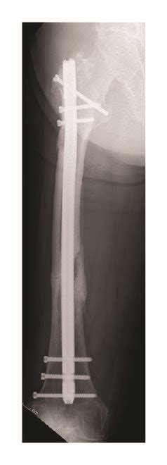 A Ap Radiographs Of A Patient With Atypical Femoral Shaft Fracture Download Scientific