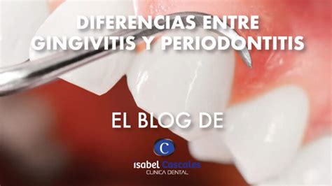 Diferencias Entre Gingivitis Y Periodontitis Clinica Dental Isabel