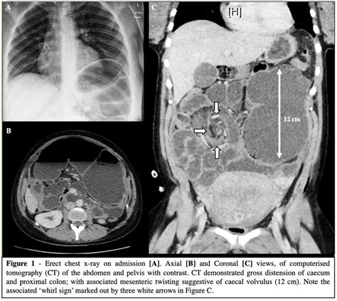 Image Taken During Colonoscopy Of The Mid Transverse Colon