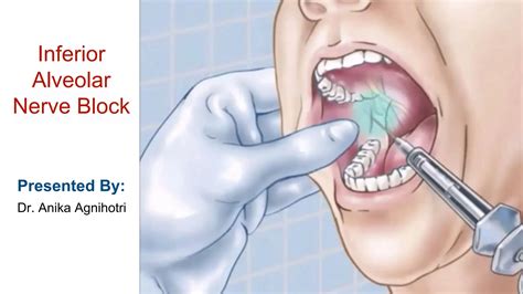 Inferior Alveolar Nerve Block Anesthetic Technique Ppt